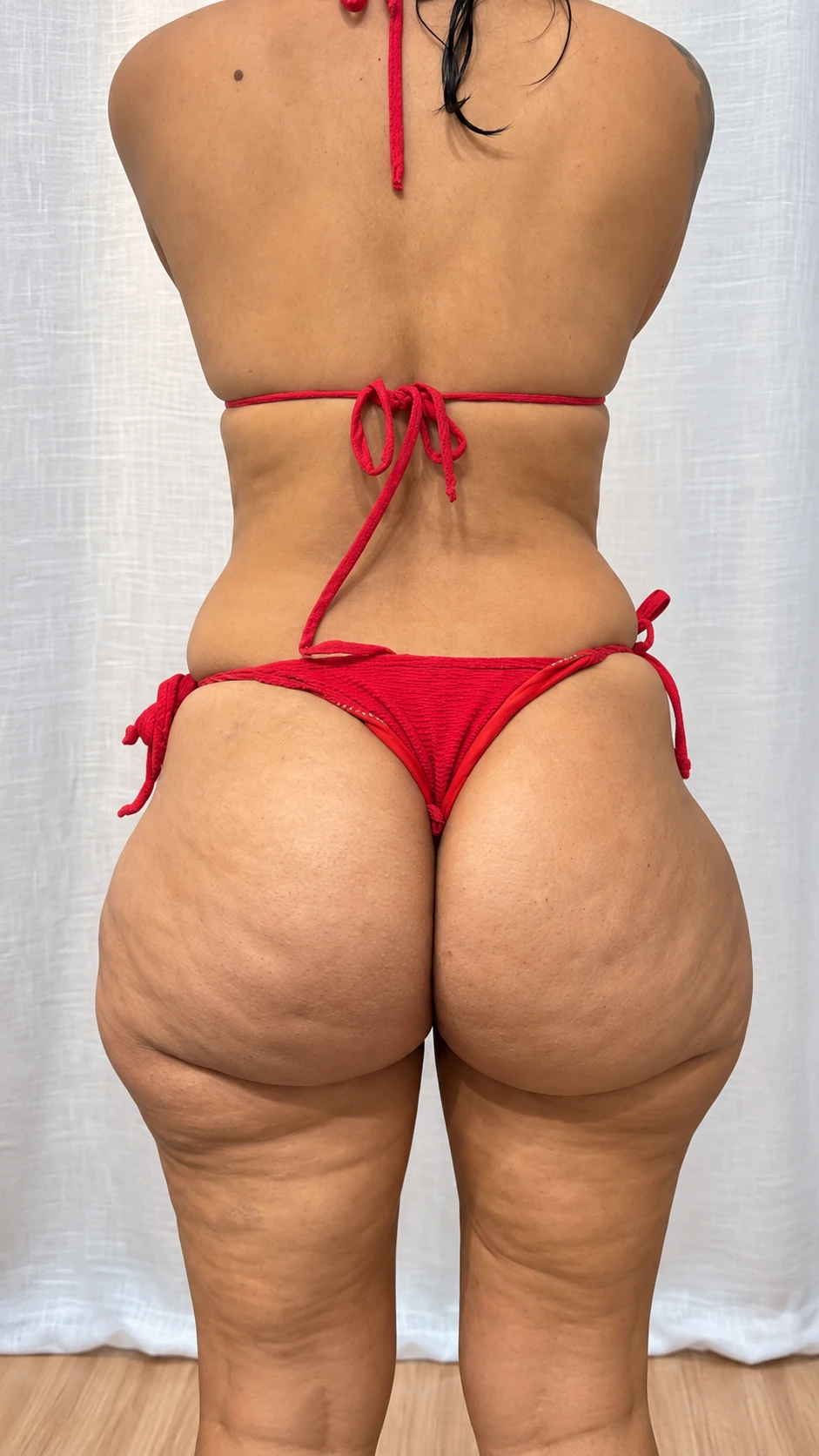 Resultado corporal antes do tratamento para lipedema