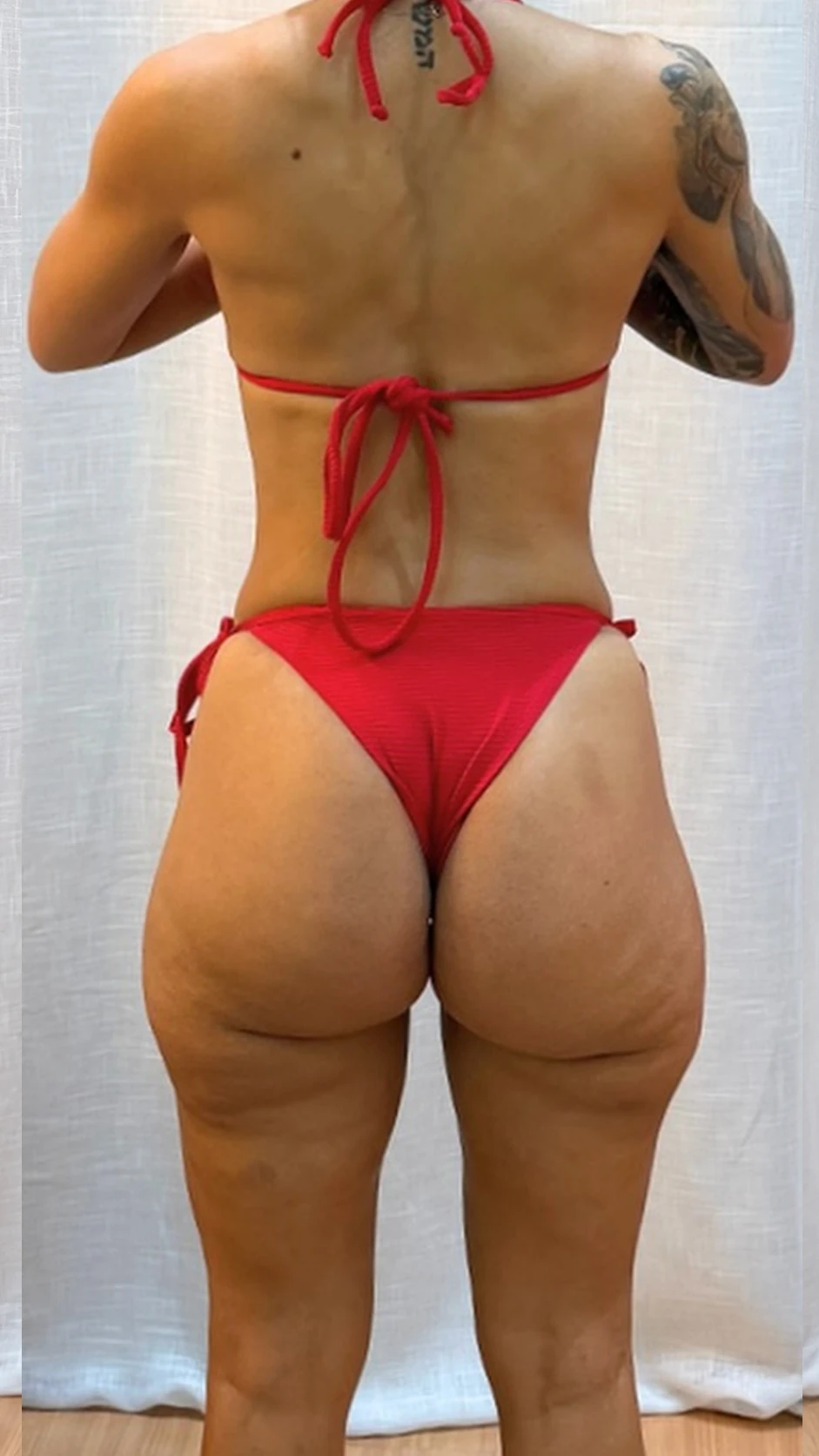 Resultado corporal depois do tratamento para lipedema
